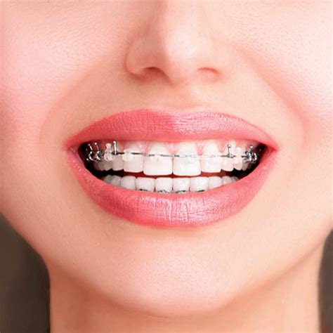 tipos de brackets metalicos autoligables|brackets autoligables precio.